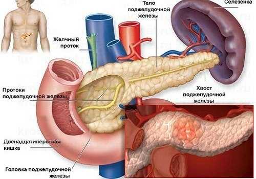 Хронический панкреатит