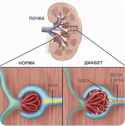 Клиническая картина сахарного диабета 1 типа