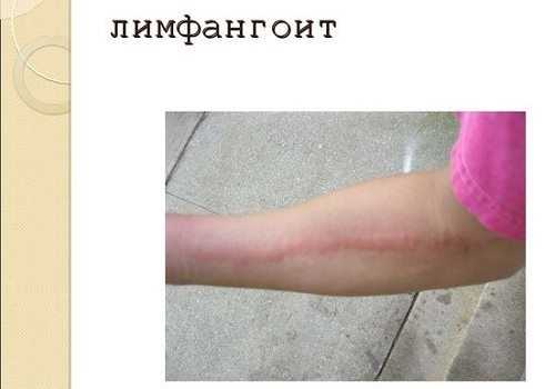 Лимфангоит