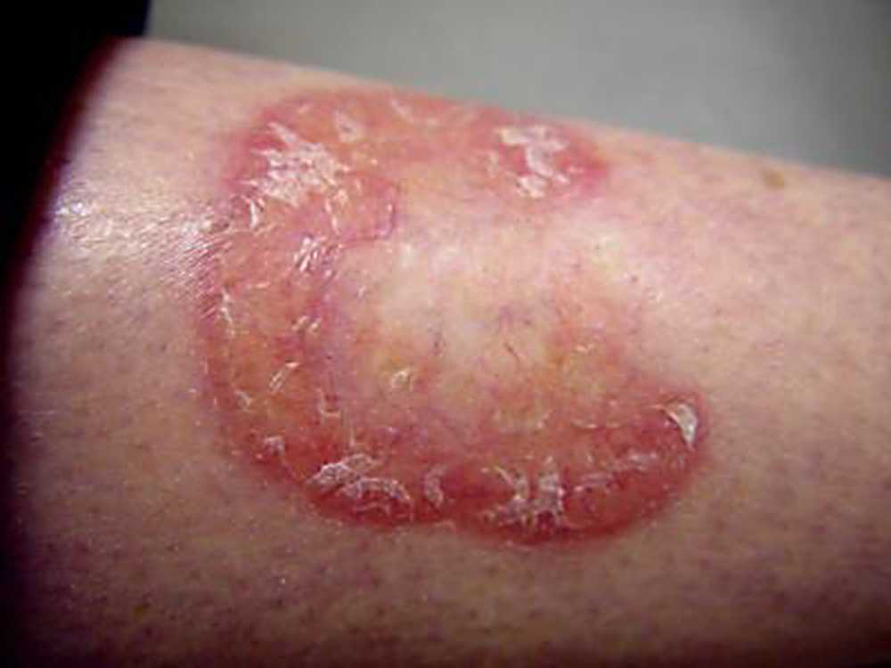 Некробиоз (Necrobiosis lipoidica diabeticorum)