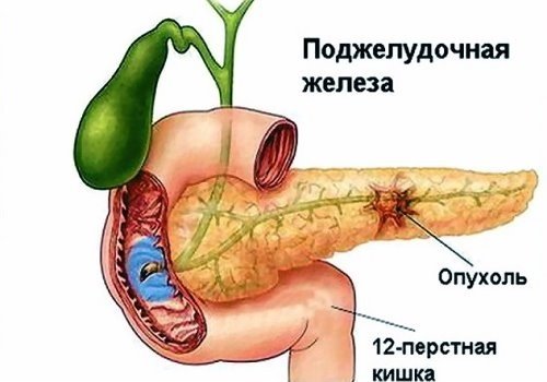 Опухоль в поджелудочной железе