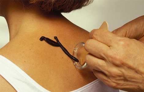 Пиявки и диабет