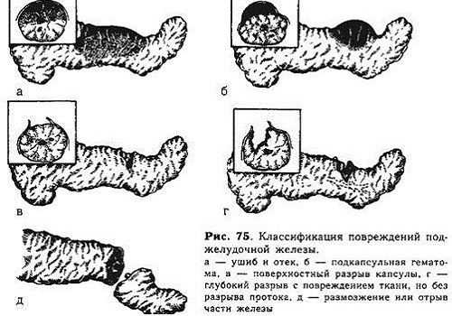 Повреждение ПЖ