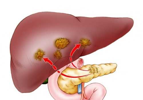 метастазирование рака ПЖ в печень