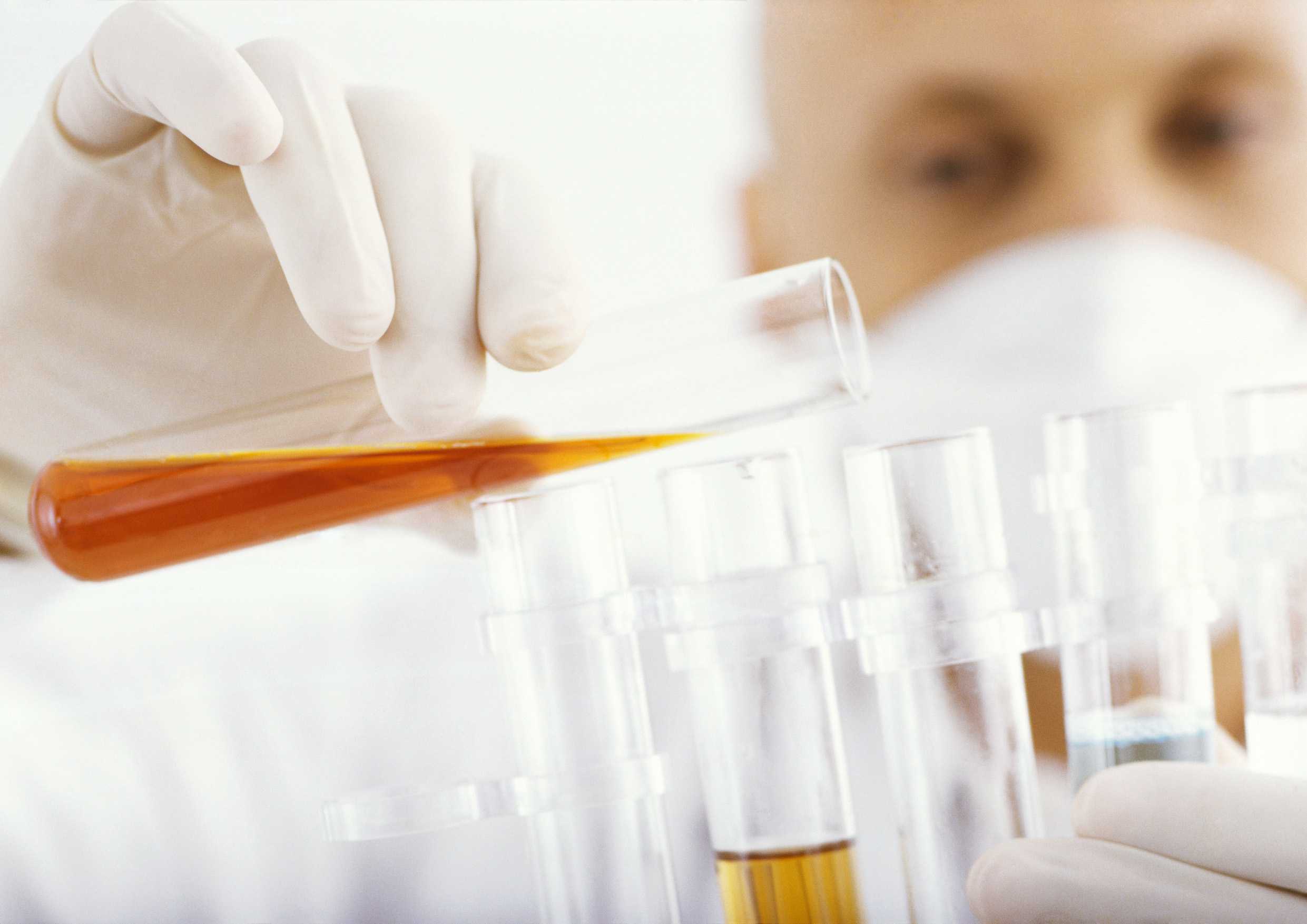 Сахара в моче во время беременности