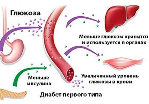 Сахарный диабет первого типа