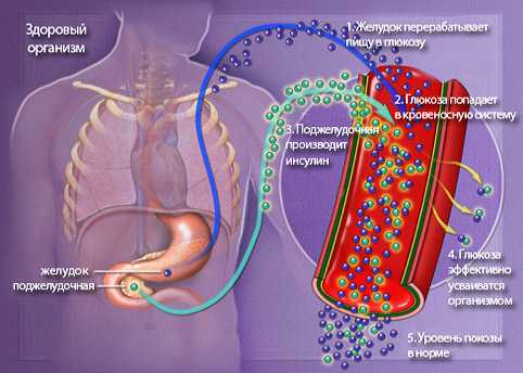 Сахарный диабет первого типа - характеристика
