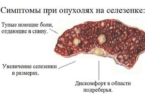 Симптомы при болях в селезенке