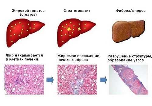 Стеатоз печени