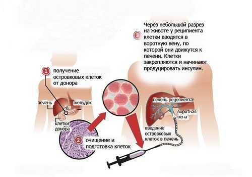 Трансплантация островковых клеток