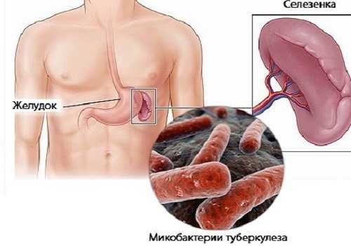 Туберкулез селезенки
