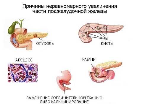 Увеличение части ПЖ