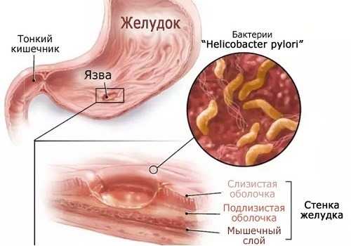 Язва желудка