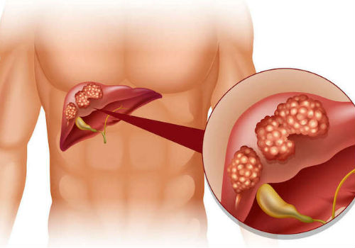 цирроз печени