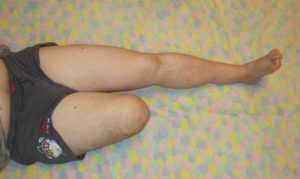 Ампутация ноги при сахарном диабете