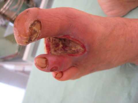 Ампутация пальцев стопы при полиневропатии у больного диабетом Ампутация пальцев стопы при полиневропатии у больного диабетом
