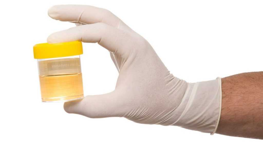 Анализ мочи