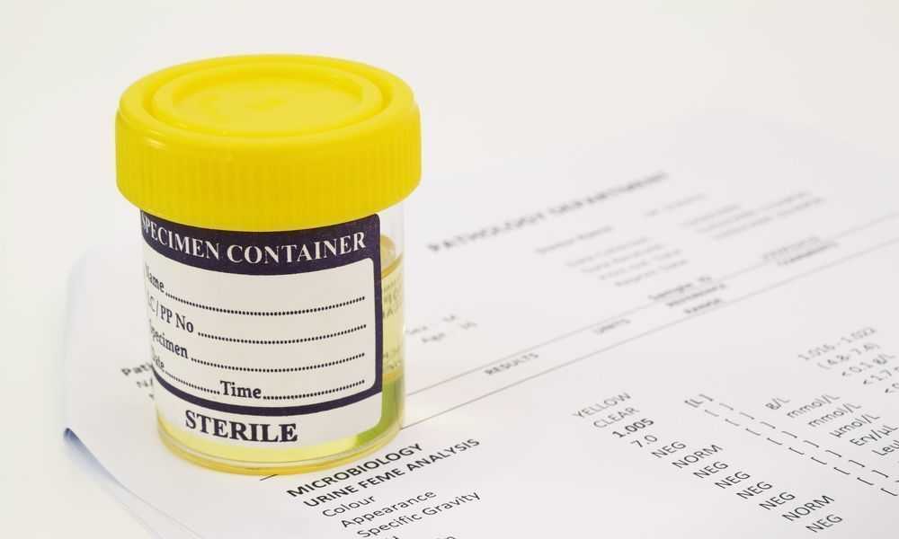 Зачем сдают мочу на сахар?