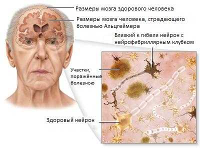 Анатомические изменения при болезни Альцгеймера Анатомические изменения при болезни Альцгеймера