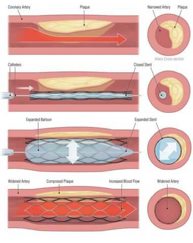 Ангиопластика со стенированием Ангиопластика со стенированием
