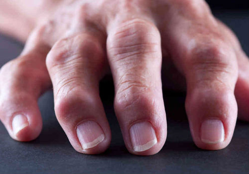 ревматоидный артрит