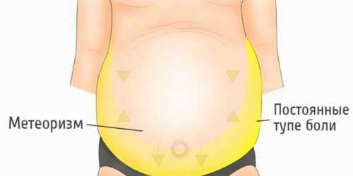 Основные проявления асцита