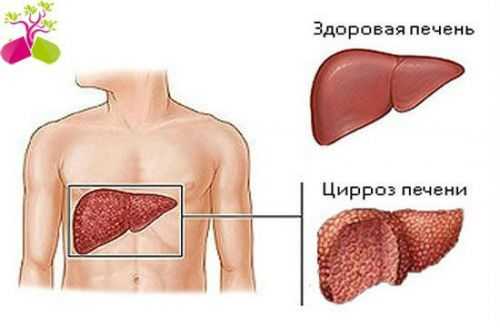 Цирроз печени
