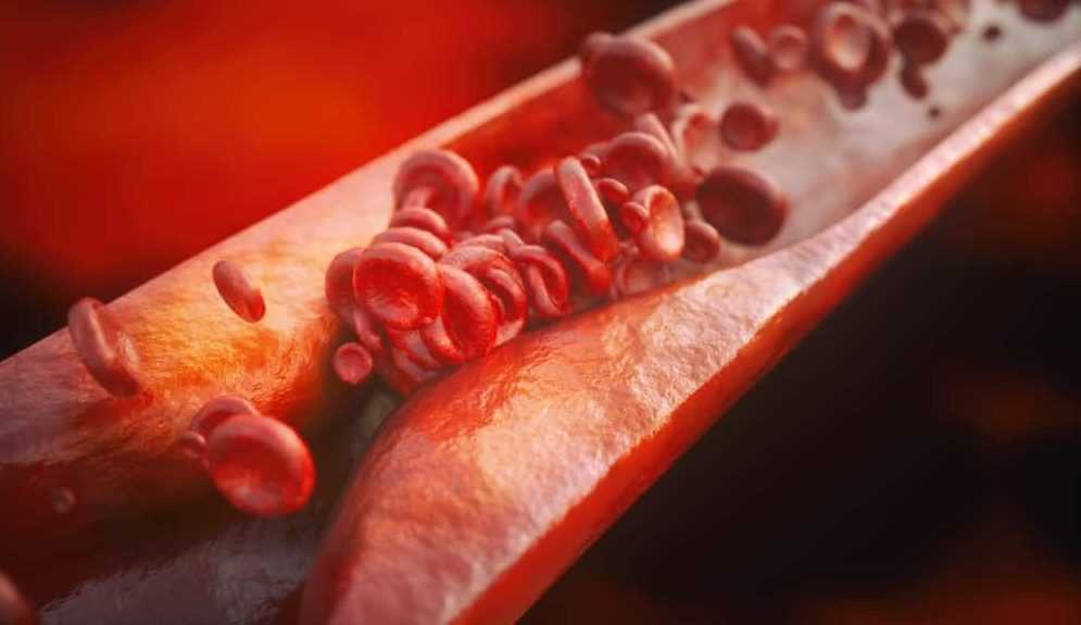 Атеросклероз