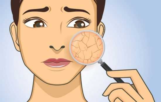 Сухость кожи лица