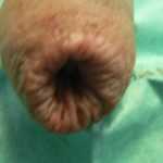 Баланит при фимозе