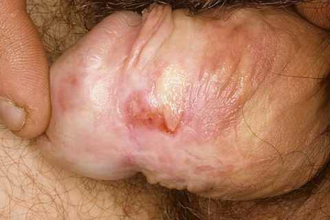 Баланит – склероатрофический лишай Баланит – склероатрофический лишай