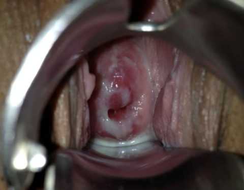 Белые выделения в сопровождении зуда и жжения при вульвовагините Белые выделения в сопровождении зуда и жжения при вульвовагините