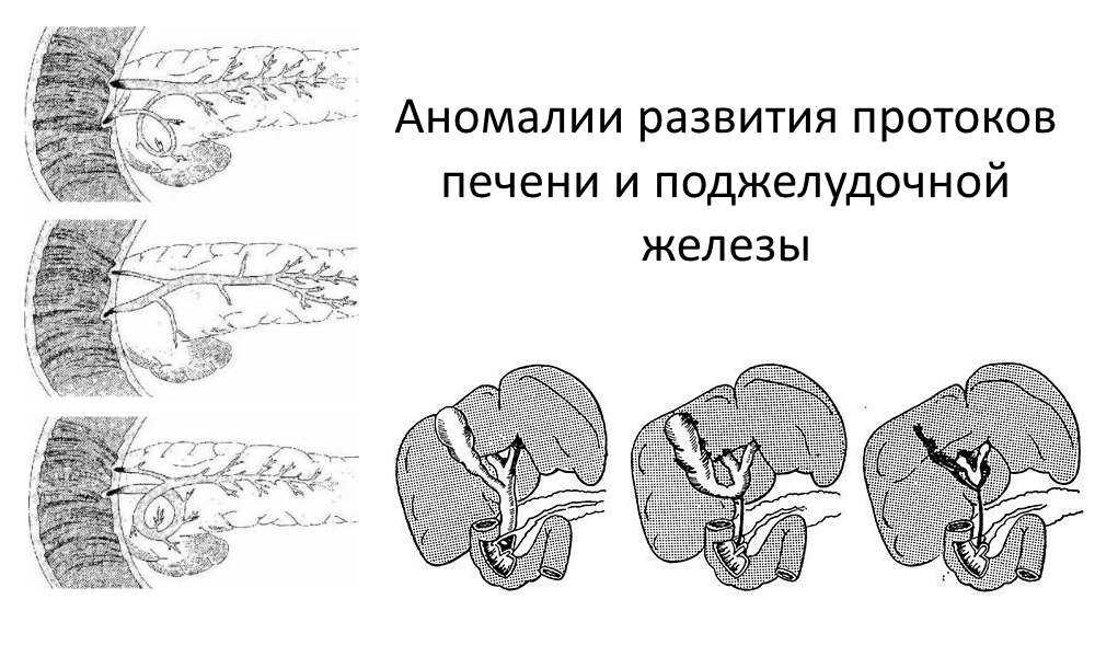 Аномалии развития протоков печени и ПЖ