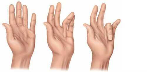 Сгибательная контрактура кистей рук