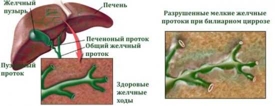 Билиарный цирроз печени