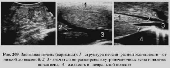 Застойная печень на УЗИ