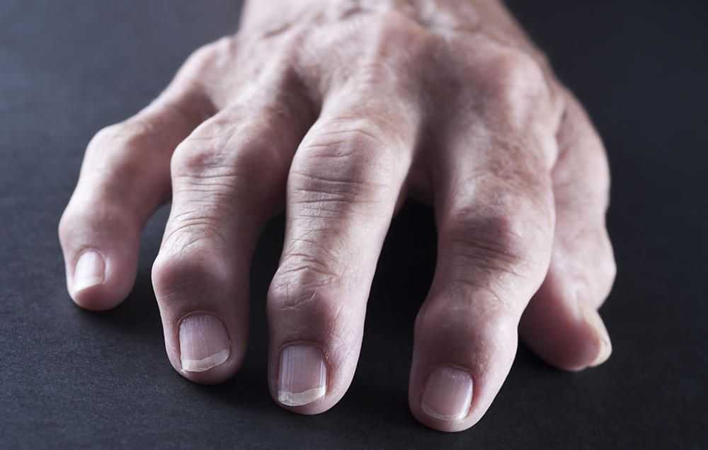 Диабетическая кисть