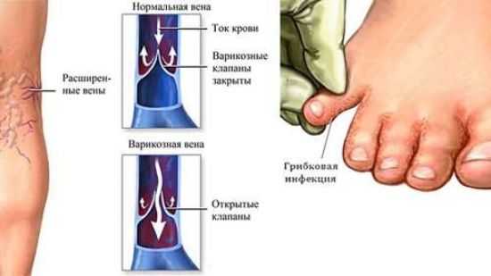 Причины боли в ногах при сахарном диабете