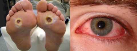 Больным с диабетической стопой или ретинопатией ЛФК подбирается с учётом этих осложнений Больным с диабетической стопой или ретинопатией ЛФК подбирается с учётом этих осложнений