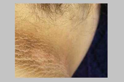 Черный актаноз