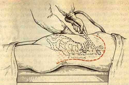 Промывание брюшной полости