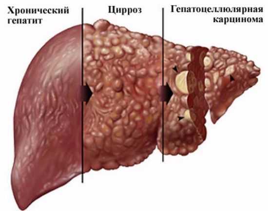 Патологии печени