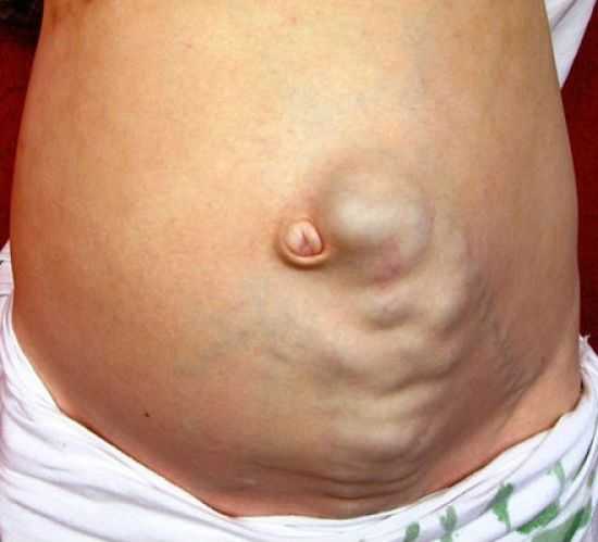 Портальная гипертензия