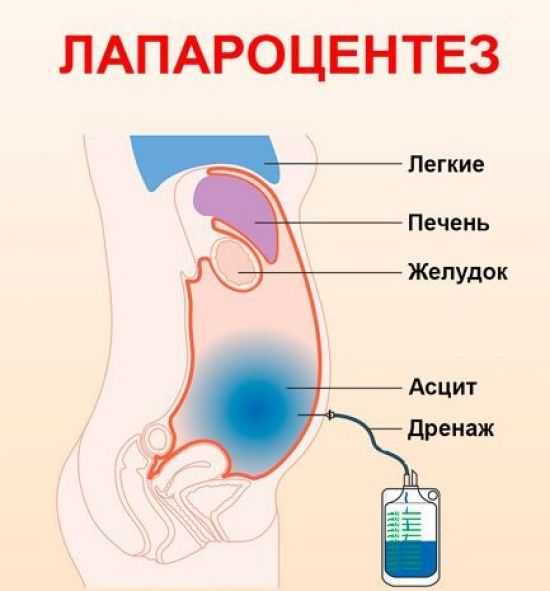 Лапароцентез