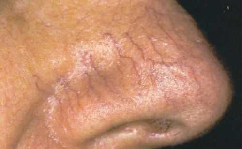 Телеангиоэктазия