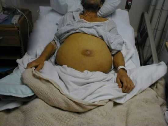 Цирроз печени