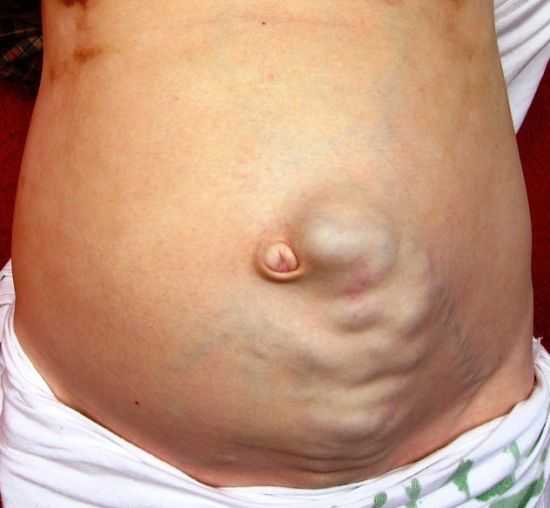 Асцит при циррозе печени