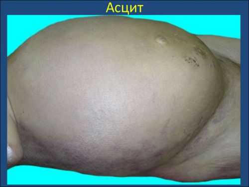 Асцит