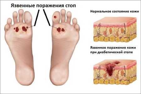Язвы на ногах Язвы на ногах