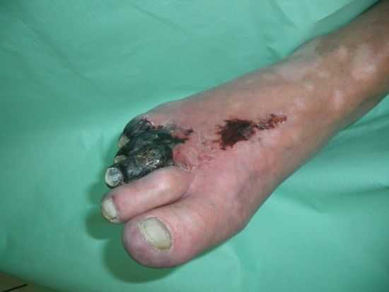 Гангрена стопы